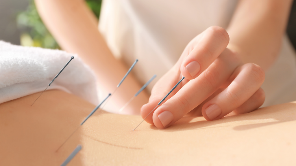 Akupunktur-Schmerzen-behandeln-Heilpraktiker-Bochum
