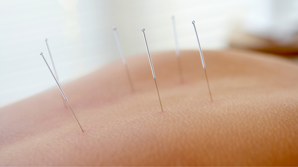 Beschwerden durch Narben lindern mit Akupunktur ganzheitlich Schmerzen behandeln Heilpraktikerin Bochum TCM