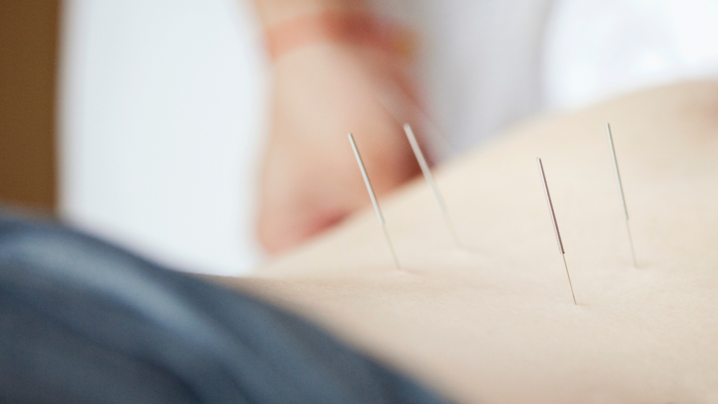 Akupunktur Rücken Schmerzen behandeln in der Nähe